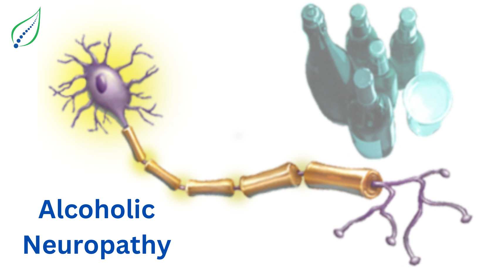 Alcoholic Neuropathy